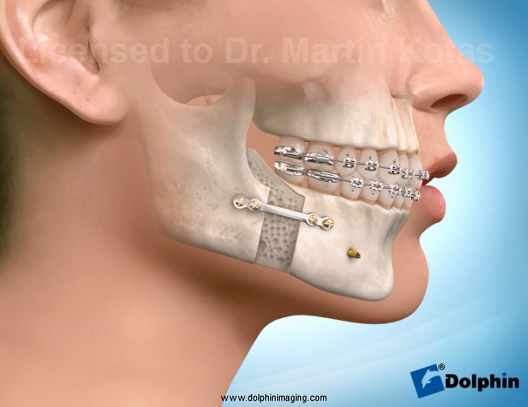 Mandibular Advancement